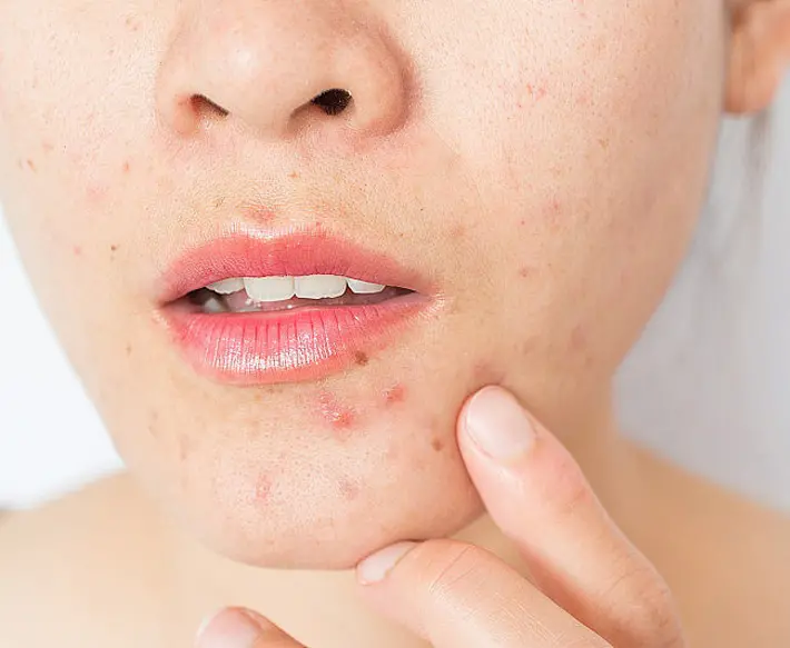 Use hapros lasers for dermatology