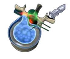 HAPROS - pldd laser fiber