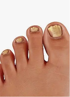 Hapros HHD-P01 treats nail fungus