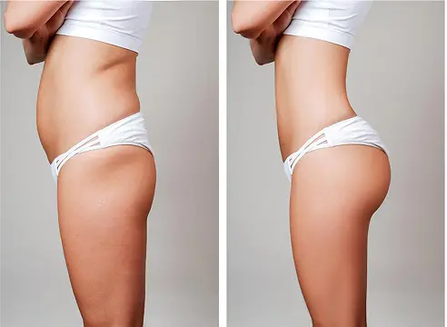 Laser Liposuction: Precise Fat Removal and Skin Tightening in One Step